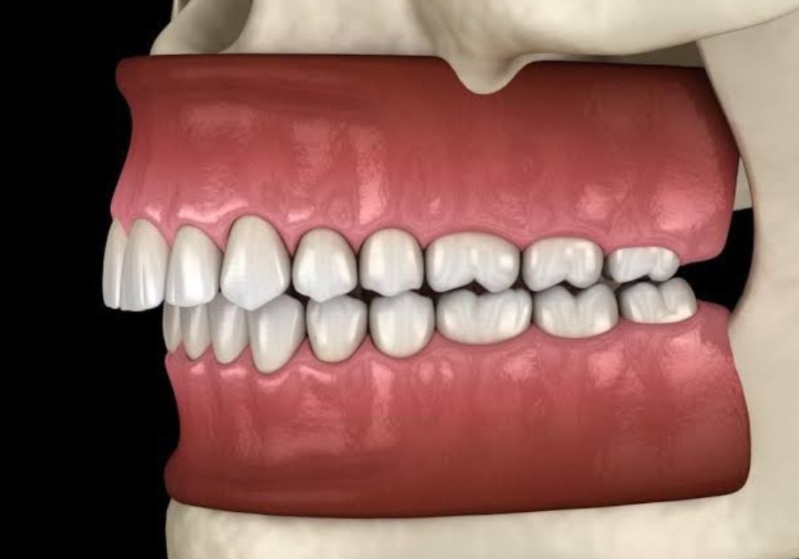 Bite concerns