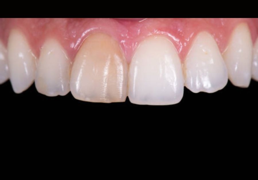 Natural tooth discolouration