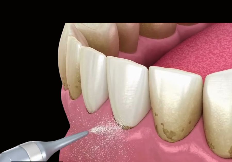 External surface staining