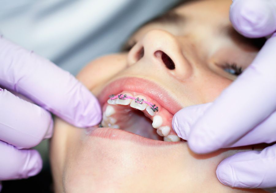 Guiding tooth position