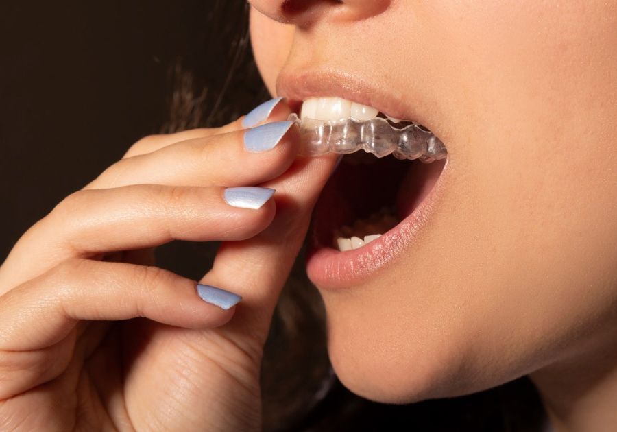 Retainers for children at Fresh Dental