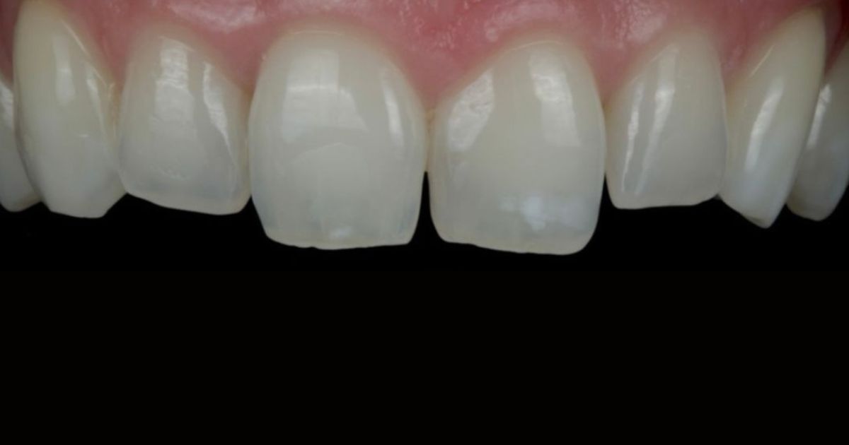 To fix gaps in a smile
