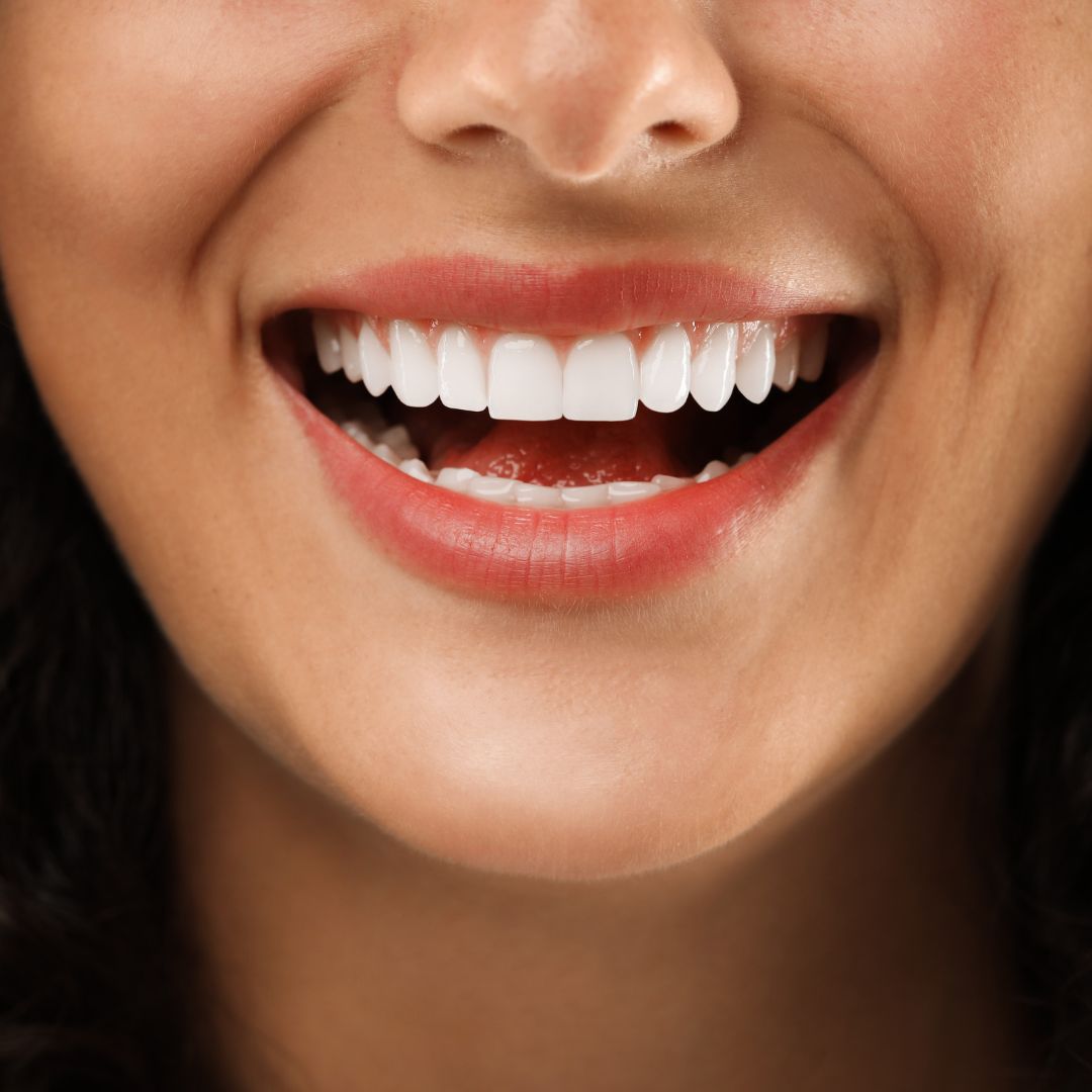 teeth whitening in London