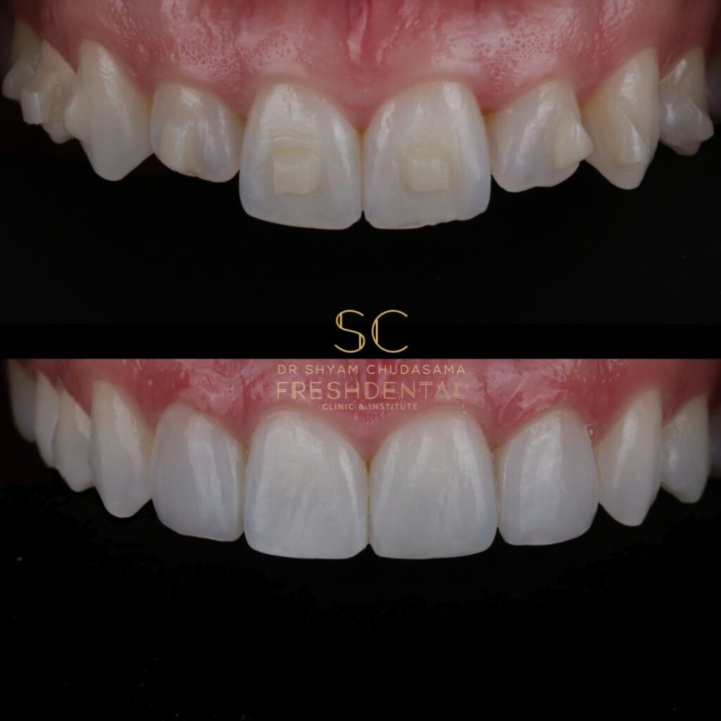 Fresh Dental smile result