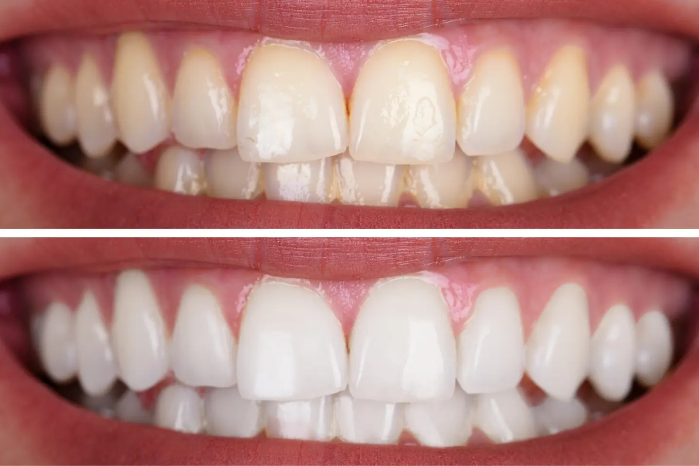 before and after teeth whitening