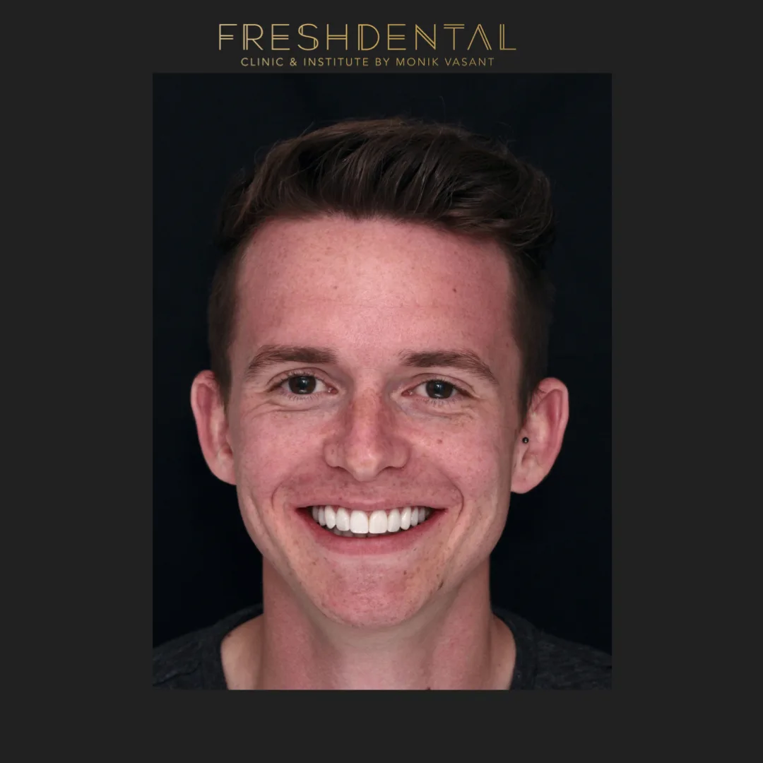 Invisalign vs braces